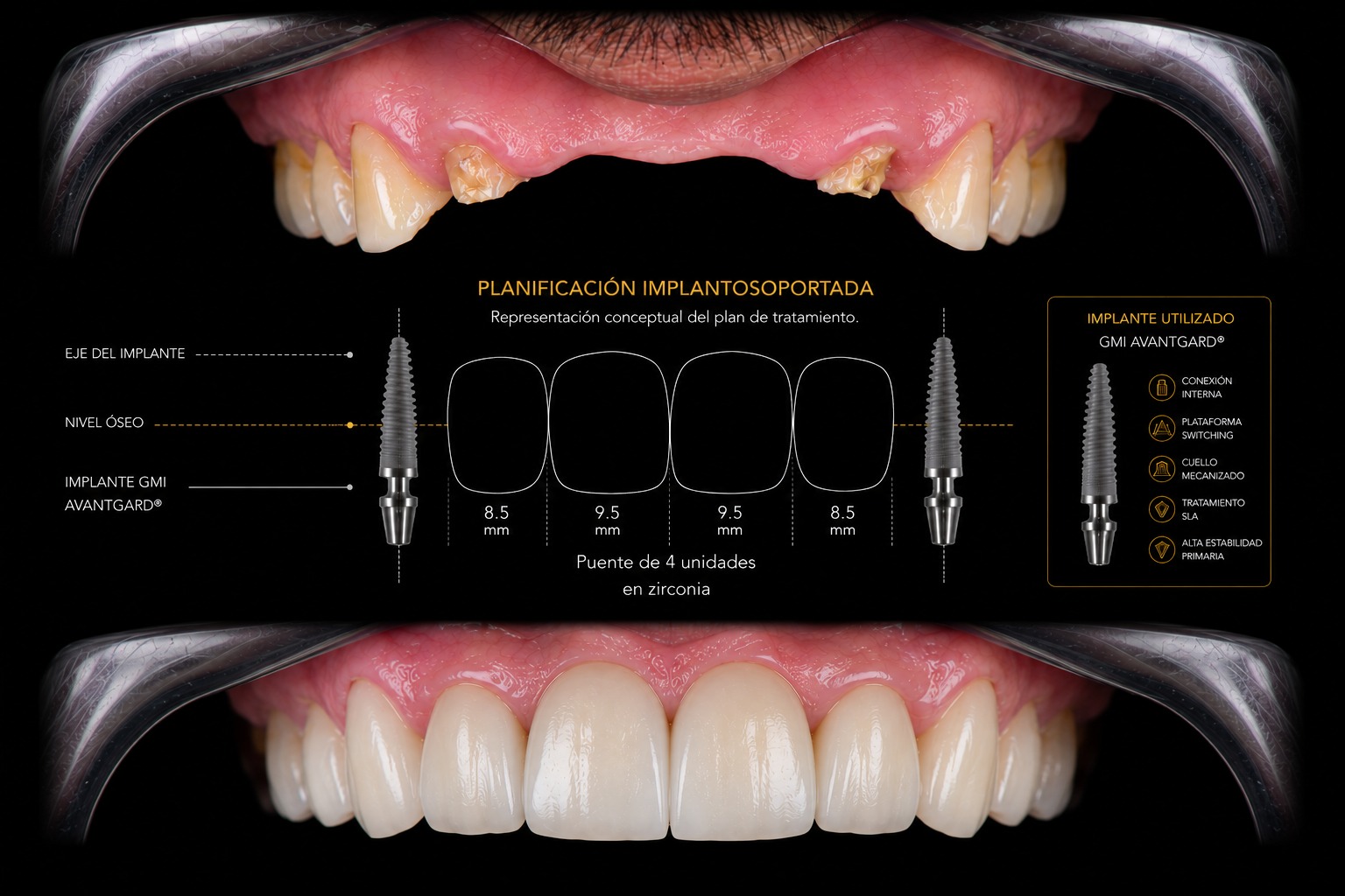 Promoción de implantes dentales en COID